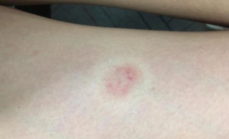 人得貓癬 人得貓癬