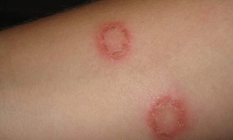 貓癬治療時間 貓癬治療時間