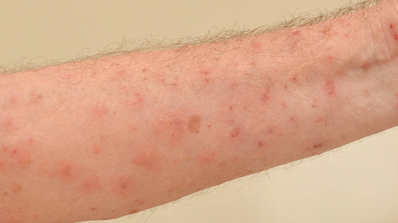 疥蟲感染原因 疥蟲感染原因