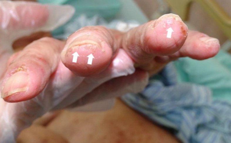 疥蟲感染原因 疥蟲感染原因