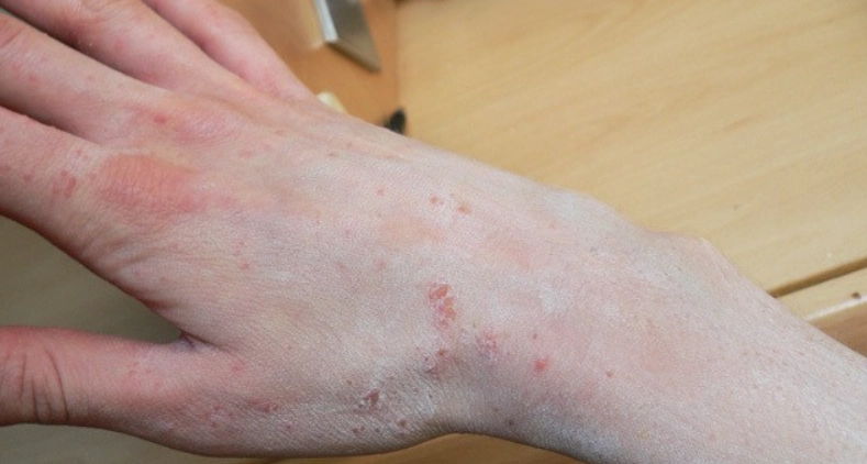 疥瘡傳染途徑 疥瘡傳染途徑