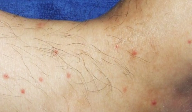 人畜共通皮膚病