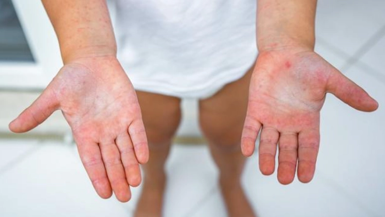 腸病毒 傳染 狗 腸病毒 傳染 狗