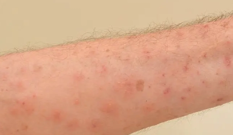 輕微疥瘡初期症狀 輕微疥瘡初期症狀