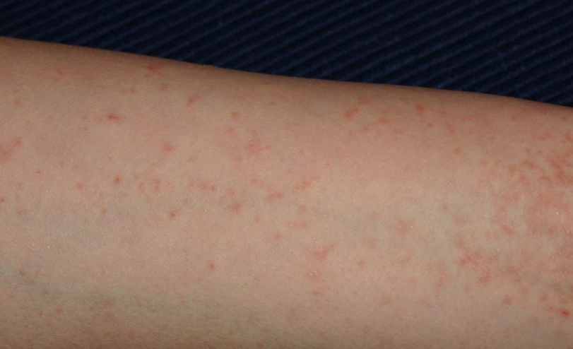 疥瘡初期治療 疥瘡初期治療