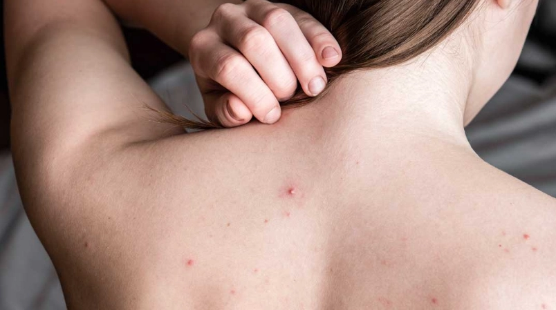 輕微疥瘡初期症狀 輕微疥瘡初期症狀