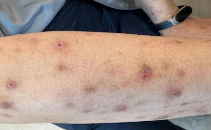 疥瘡初期治療 疥瘡初期治療