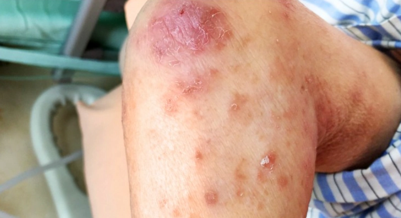 疥瘡治療時間 疥瘡治療時間