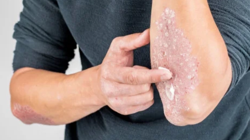 疥瘡治療時間 疥瘡治療時間