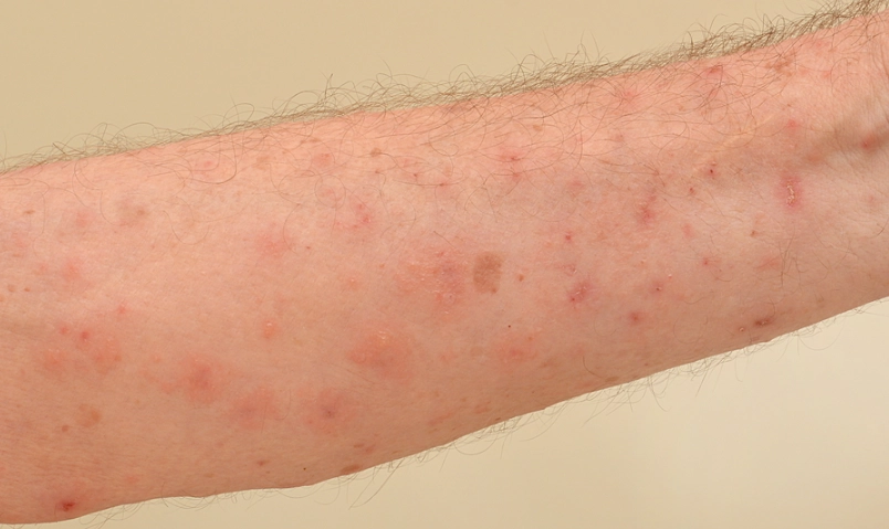 疥瘡藥膏 疥瘡藥膏