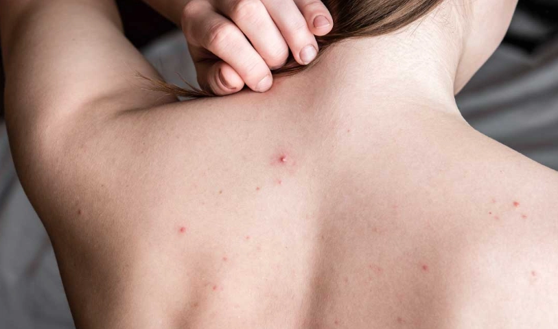 疥瘡症狀 疥瘡症狀