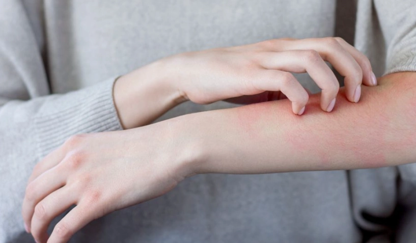 疥瘡初期症狀全解析：如何分辨惱人的夜間劇癢？