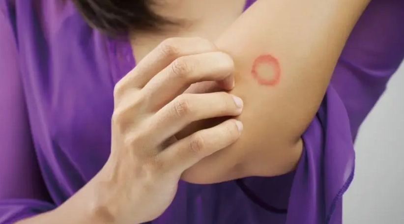 貓癬傳染人 貓癬傳染人