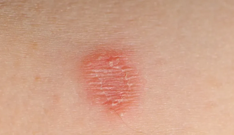 貓癬治療方法 貓癬治療方法