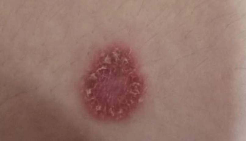 貓癬傳染人 貓癬傳染人