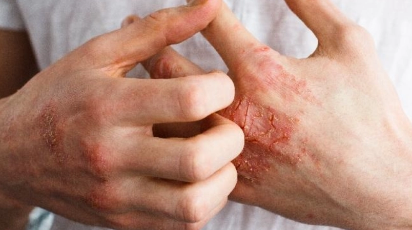 手部濕疹根治指南：告別乾癢紅腫的皮膚護理對策