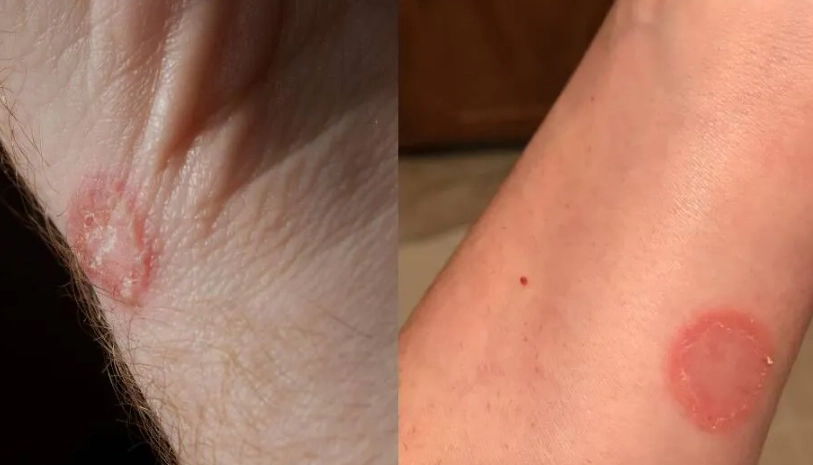 貓癬治療 貓癬治療