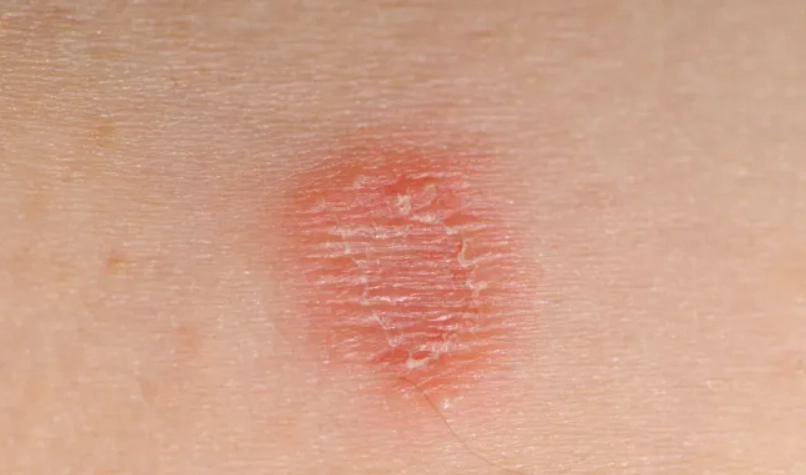 貓癬症狀 貓癬症狀