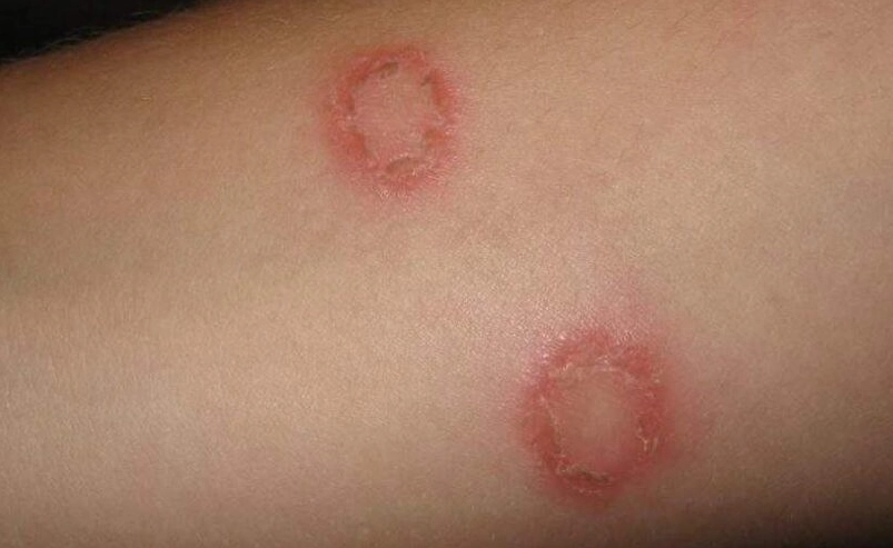 貓癬治療 貓癬治療