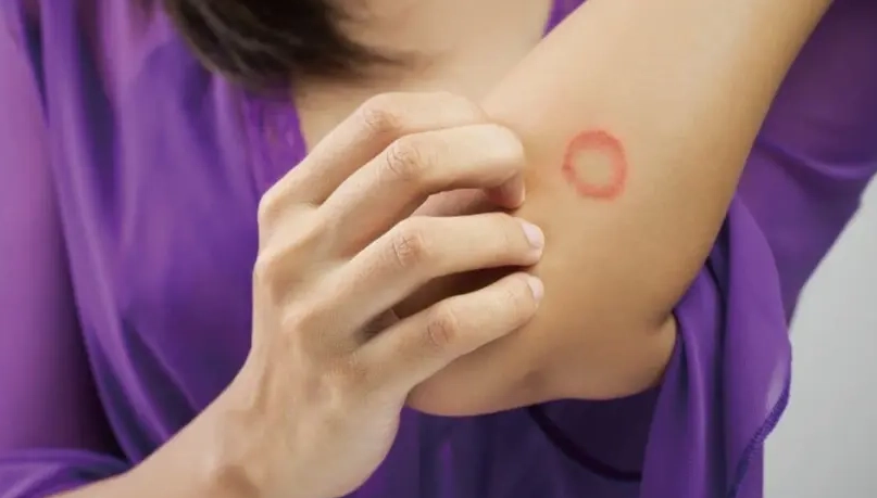 貓癬症狀 貓癬症狀