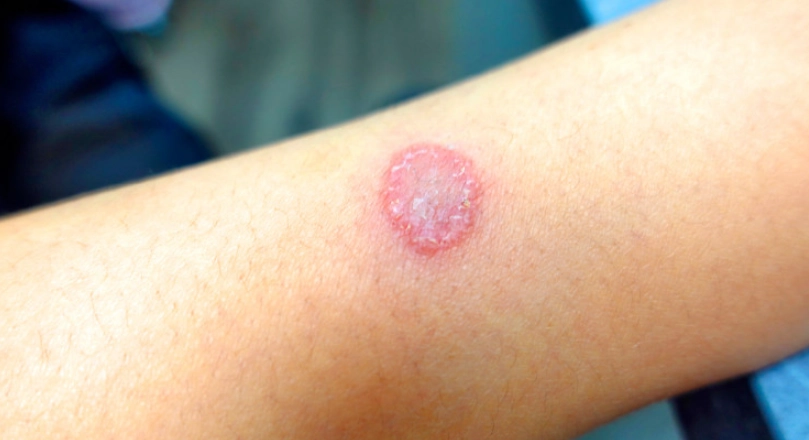 貓癬治療 貓癬治療