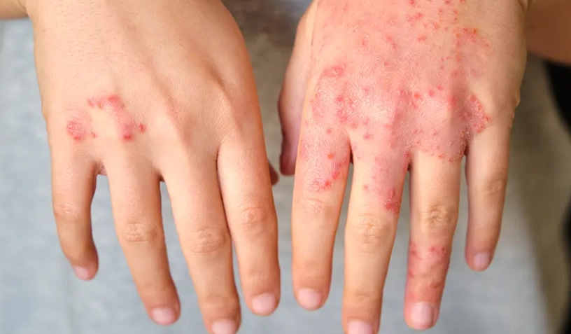 手部濕疹治療方法