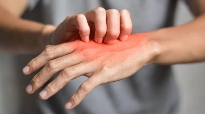 疥瘡初期症狀 疥瘡初期症狀