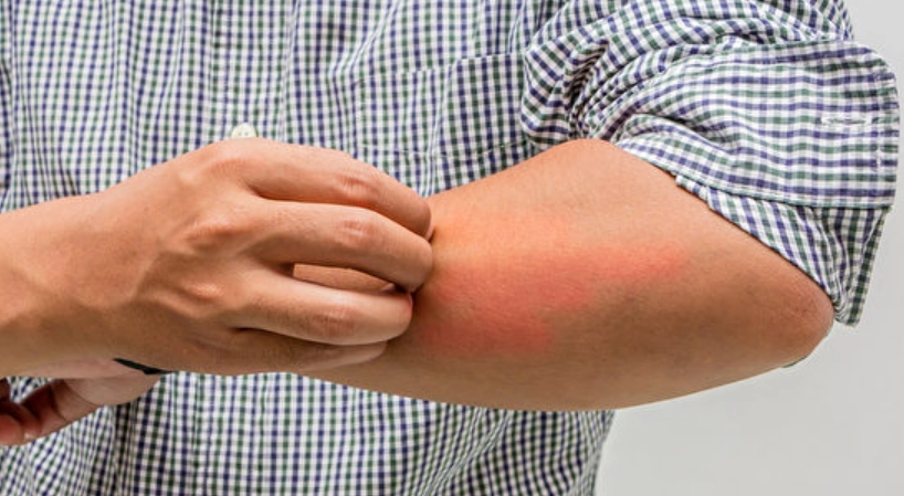 疥瘡可以洗澡嗎 疥瘡可以洗澡嗎