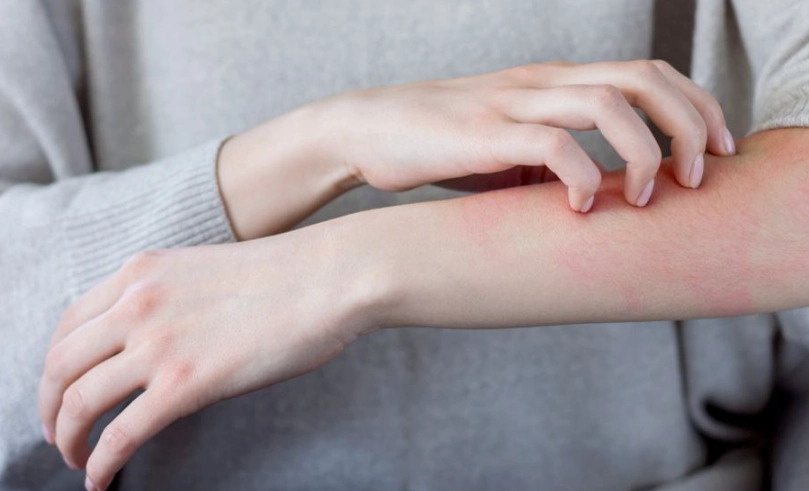 疥瘡初期症狀 疥瘡初期症狀