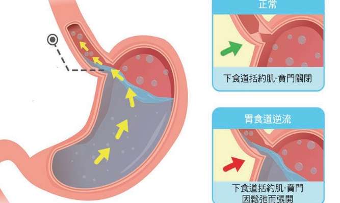 茶油胃食道逆流