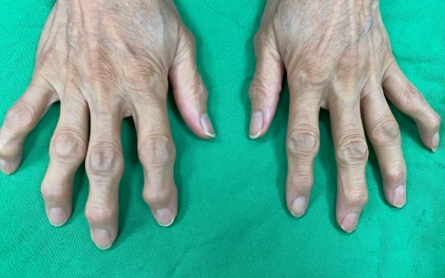 指間炎康復時間