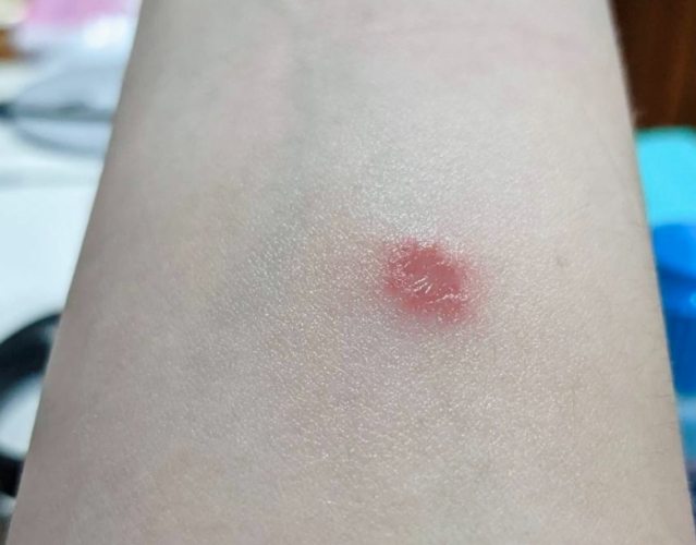 貓癬症狀人類 貓癬症狀人類