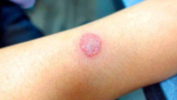 貓癬人傳人症狀 貓癬人傳人症狀