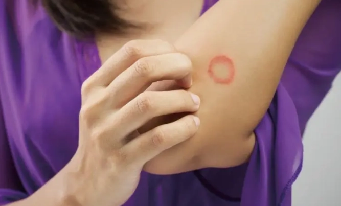 貓癬治療方法 貓癬治療方法