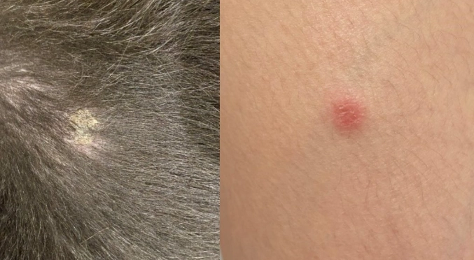 貓癬人傳人症狀 貓癬人傳人症狀