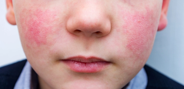 细小病毒症状 细小病毒症状