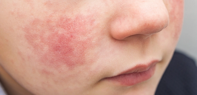 细小病毒症状 细小病毒症状