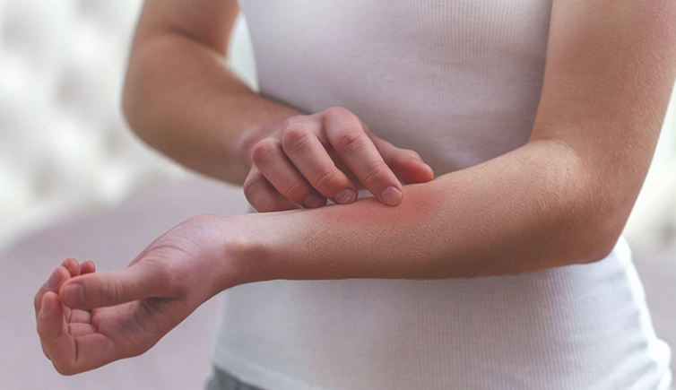 疥蟲感染症狀 疥蟲感染症狀