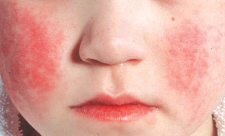 细小病毒症状 细小病毒症状