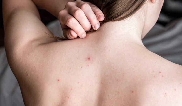 疥蟲治療 疥蟲治療