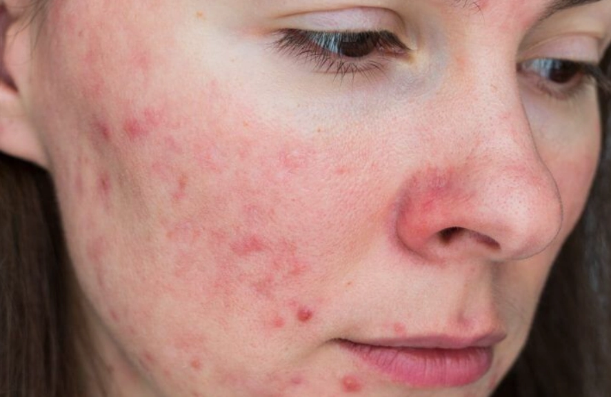 椰子油過敏治療