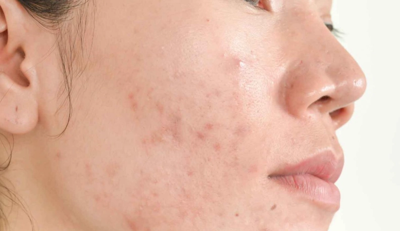 椰子油過敏治療