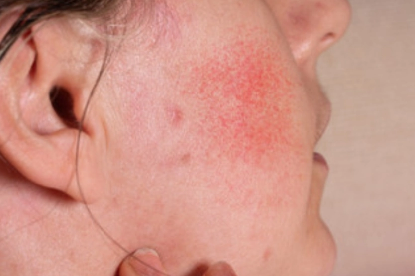 椰子油治療濕疹 椰子油治療濕疹