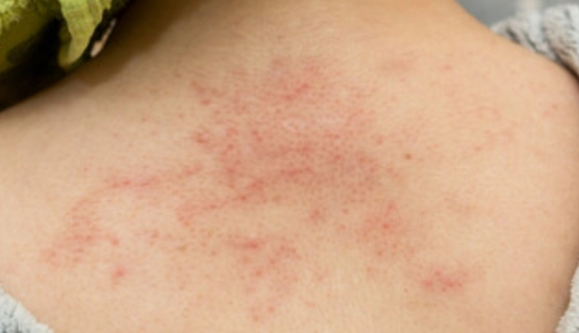 椰子油治療濕疹 椰子油治療濕疹