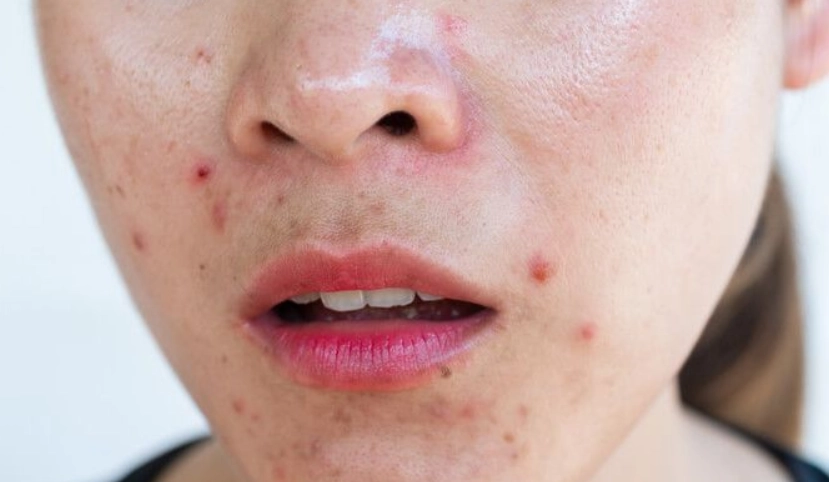 椰子油皮膚炎預防