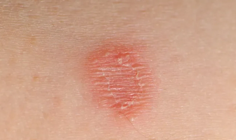 貓癬治療 貓癬治療