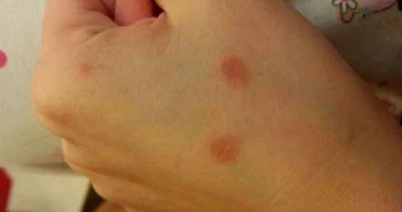 貓癬症狀 貓癬症狀