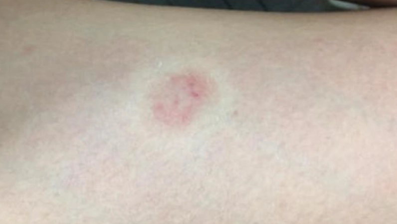 貓癬症狀 貓癬症狀