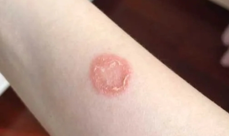 貓癬症狀 貓癬症狀