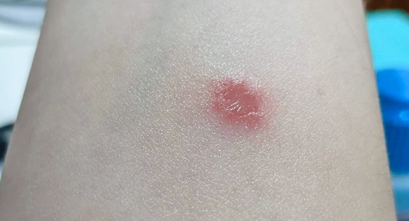 貓癬症狀 貓癬症狀